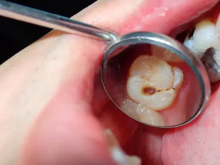 Dental Implantation in India