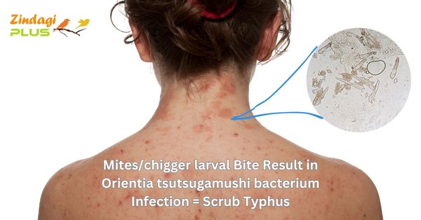 स्क्रब टाइफस, Scrub Typhus, Bacterial Infection, Skin Patches, scrub typhus symptoms